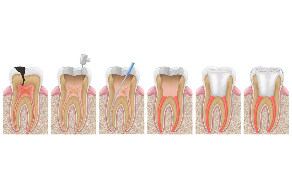 root-canals